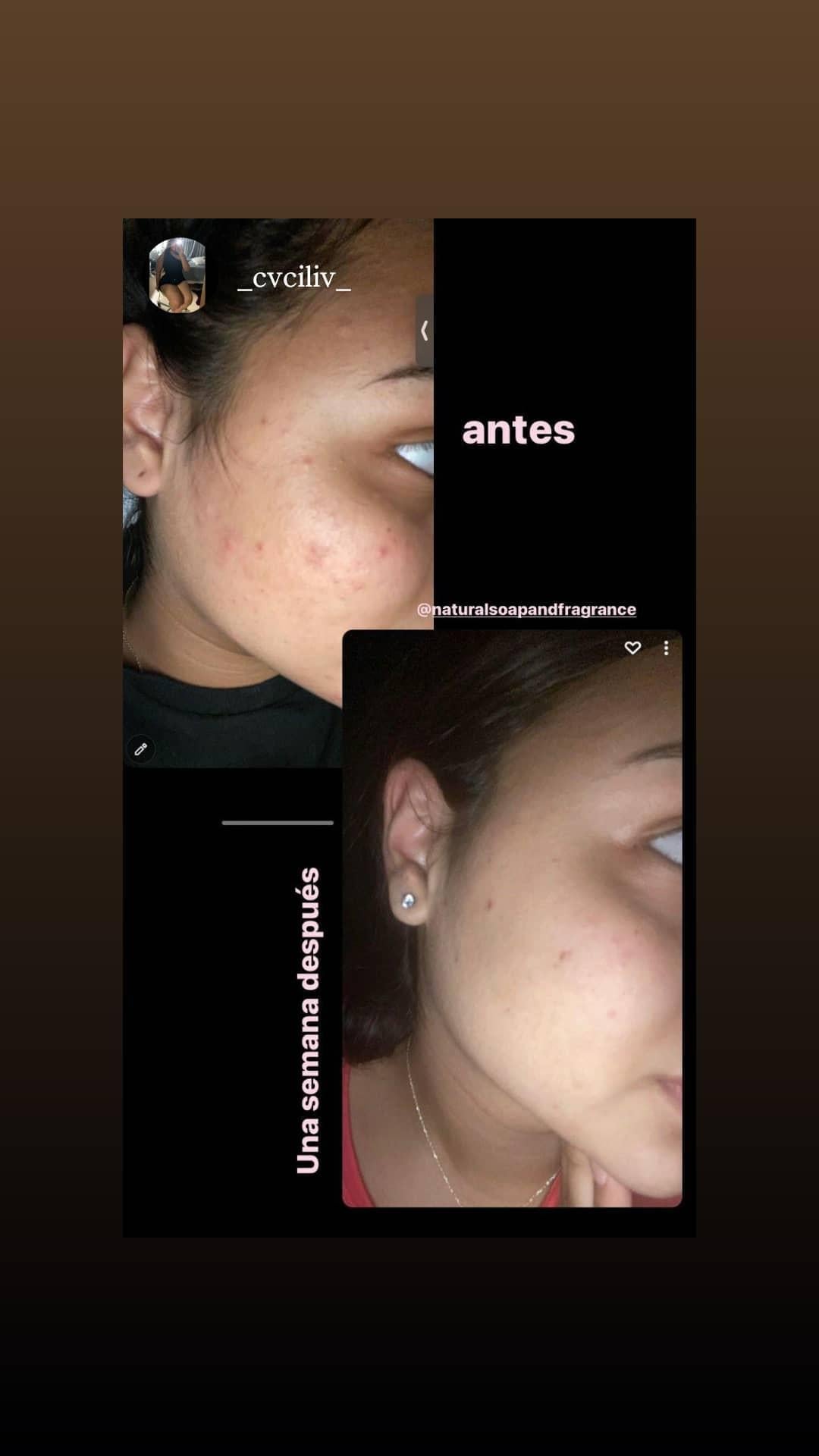 Scrub de Tomate para el acne y puntos negros